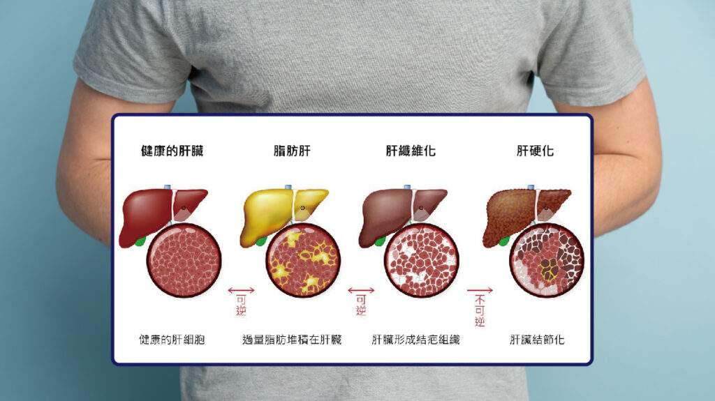 肝臟病變四階段演變示意圖，展示從健康肝臟、脂肪肝、肝纖維化到肝硬化的視覺對比，用於說明代謝負債的累積過程。