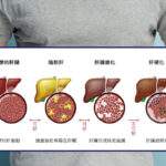 肝臟病變四階段演變示意圖，展示從健康肝臟、脂肪肝、肝纖維化到肝硬化的視覺對比，用於說明代謝負債的累積過程。