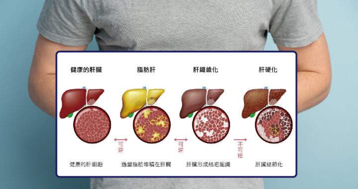 肝臟病變四階段演變示意圖，展示從健康肝臟、脂肪肝、肝纖維化到肝硬化的視覺對比，用於說明代謝負債的累積過程。